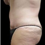 Liposuction and Mommy Makeover Before & After Patient #1112