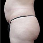 Liposuction and Mommy Makeover Before & After Patient #1133