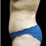 Liposuction and Mommy Makeover Before & After Patient #1150