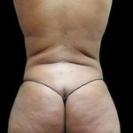 Liposuction and Mommy Makeover Before & After Patient #1157