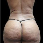Liposuction and Mommy Makeover Before & After Patient #1177