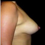 Liposuction and Breast Reduction Before & After Patient #683