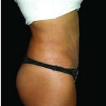 Liposuction and Mommy Makeover Before & After Patient #1193