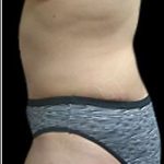 Liposuction and Mommy Makeover Before & After Patient #1218