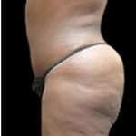 Liposuction and Mommy Makeover Before & After Patient #1231