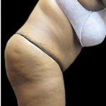 Liposuction and Mommy Makeover Before & After Patient #1240