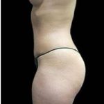 Liposuction and Mommy Makeover Before & After Patient #1247