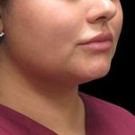 Laser Neck Lift and Submental Liposuction Before & After Patient #1258
