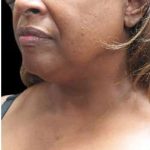 Laser Neck Lift and Submental Liposuction Before & After Patient #1265