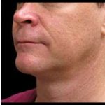 Laser Neck Lift and Submental Liposuction Before & After Patient #1272