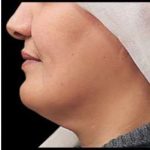 Laser Neck Lift and Submental Liposuction Before & After Patient #1279