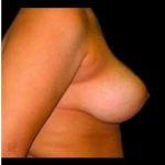 Liposuction and Breast Reduction Before & After Patient #694