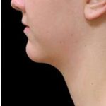 Laser Neck Lift and Submental Liposuction Before & After Patient #1286