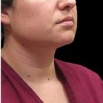 Laser Neck Lift and Submental Liposuction Before & After Patient #1297