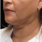 Laser Neck Lift and Submental Liposuction Before & After Patient #1315