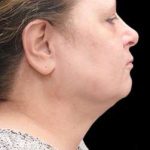 Laser Neck Lift and Submental Liposuction Before & After Patient #1328
