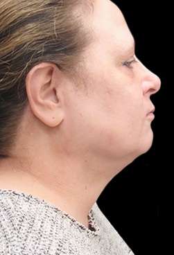 Laser Neck Lift and Submental Liposuction Before & After Patient #1328