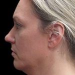 Laser Neck Lift and Submental Liposuction Before & After Patient #1335