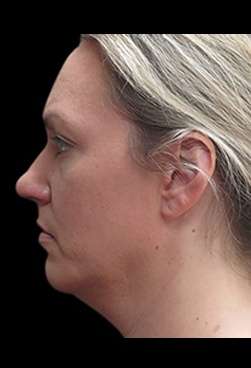 Laser Neck Lift and Submental Liposuction Before & After Patient #1335