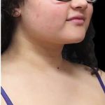 Laser Neck Lift and Submental Liposuction Before & After Patient #1346