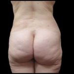 Super Wet Liposuction Before & After Patient #1353