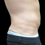 Super Wet Liposuction Before & After Patient #1367