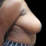 Liposuction and Breast Reduction Before & After Patient #705