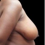 Liposuction and Breast Reduction Before & After Patient #639