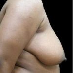 Liposuction and Breast Reduction Before & After Patient #726