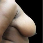 Liposuction and Breast Reduction Before & After Patient #733