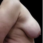 Liposuction and Breast Reduction Before & After Patient #740