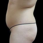 Laser Liposuction and Cellulaze Before & After Patient #759