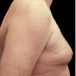 Liposuction and Gynecomastia Before & After Patient #775