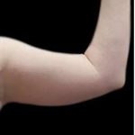 Arm Liposuction Before & After Patient #622