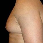 Liposuction and Gynecomastia Before & After Patient #786