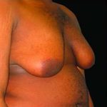 Liposuction and Gynecomastia Before & After Patient #793