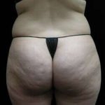 Female Liposuction Before & After Patient #825