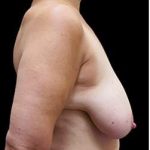 Liposuction and Breast Reduction Before & After Patient #650