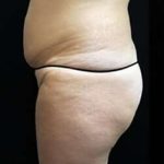 Female Liposuction Before & After Patient #834