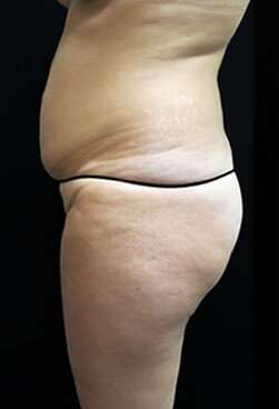 Female Liposuction Before & After Patient #834