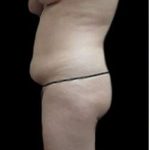 Female Liposuction Before & After Patient #843