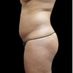 Female Liposuction Before & After Patient #852