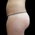 Female Liposuction Before & After Patient #877