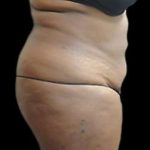 Female Liposuction Before & After Patient #887