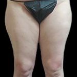 Female Liposuction Before & After Patient #894