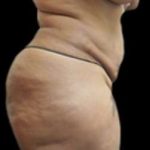 Female Liposuction Before & After Patient #908