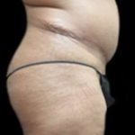 Female Liposuction Before & After Patient #915