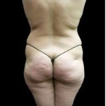 Female Liposuction Before & After Patient #930