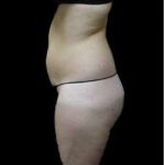 Female Liposuction Before & After Patient #939