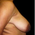 Liposuction and Breast Reduction Before & After Patient #661
